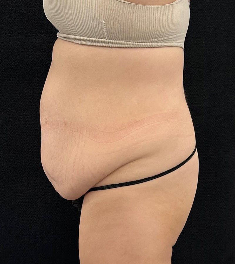 Lower Body Lift Before & After Gallery - Patient 720624 - Image 9