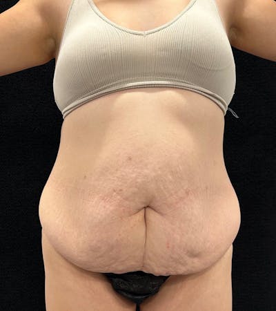 Lower Body Lift Before & After Gallery - Patient 720624 - Image 1