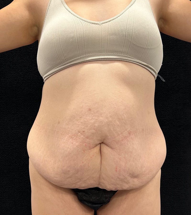 Lower Body Lift Before & After Gallery - Patient 720624 - Image 1