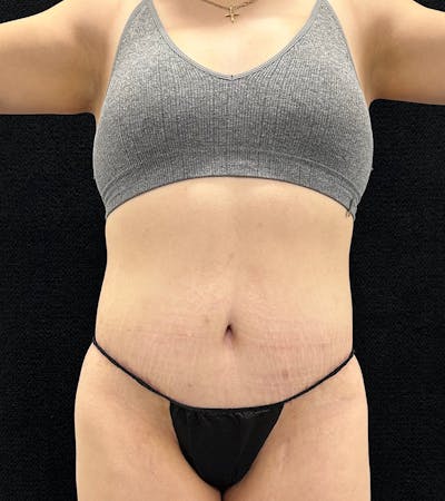 Lower Body Lift Before & After Gallery - Patient 720624 - Image 2
