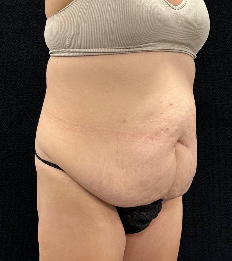 Lower Body Lift Before & After Gallery - Patient 720624 - Image 3