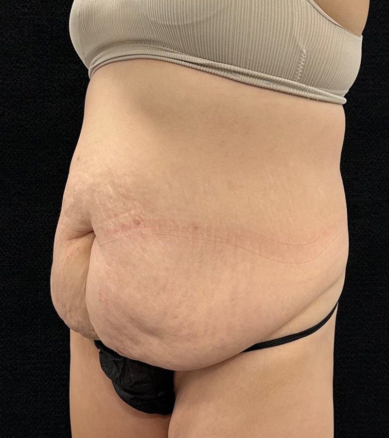 Lower Body Lift Before & After Gallery - Patient 720624 - Image 7