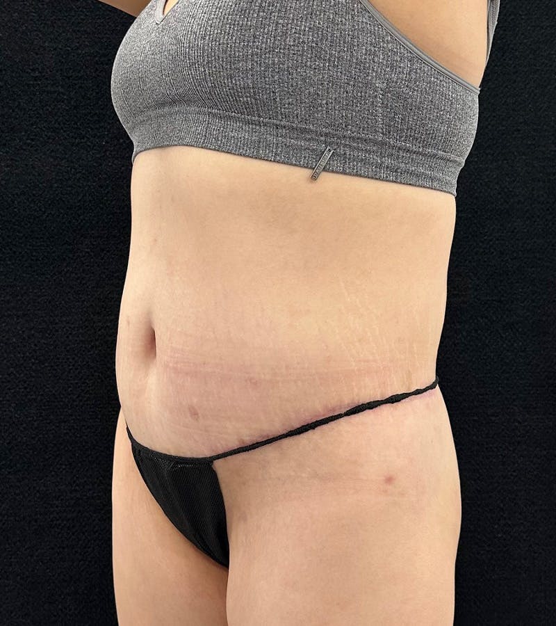 Lower Body Lift Before & After Gallery - Patient 720624 - Image 8