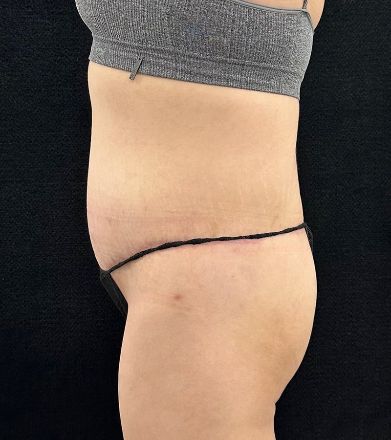Lower Body Lift Before & After Gallery - Patient 720624 - Image 10