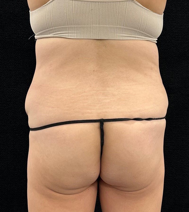 Lower Body Lift Before & After Gallery - Patient 720624 - Image 11