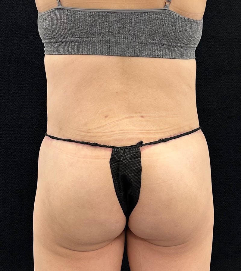 Lower Body Lift Before & After Gallery - Patient 720624 - Image 12