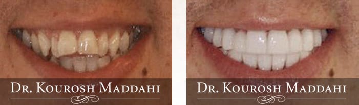 Overbite correction before and after photo by Dr. Maddahi
