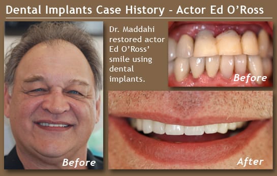 Collage of photos of Ed O' Ross after receiving dental implants from Dr. Maddahi