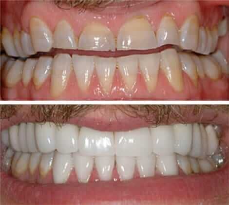 Anti aging dentistry before and after: close up of man's teeth before and after