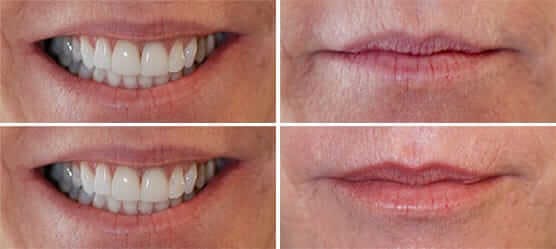 Anti aging dentistry before and after: close up of woman's smile before and after 02