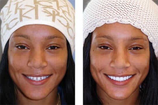 Anti aging dentistry before and after: close up of woman's teeth before and after 02