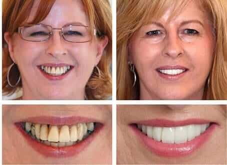 Anti aging dentistry before and after: close up of woman's teeth before and after