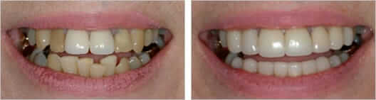 Veneers & Crowns Before & After Photo