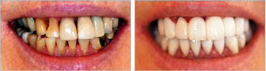 Gum disease treatment before and after photo