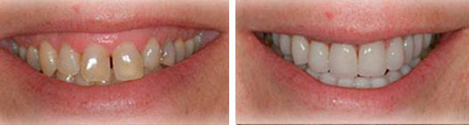 Fixed gummy smile before and after photo