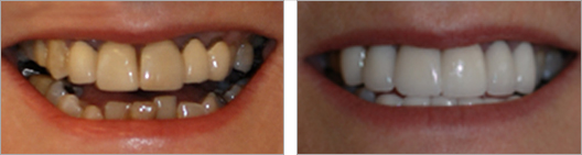 Metal fillings, crowns or inlays before and after photo