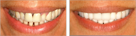 Fixed gaps between teeth before and after photo