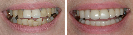 Fixed old, failing dental work before and after photo