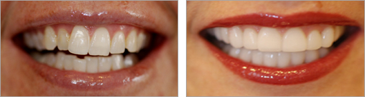 Fixed unevenly sized teeth before and after photo