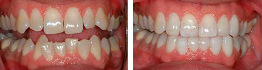 Fixed overcrowded teeth before and after photo