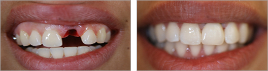 Missing teeth fix before and after photo