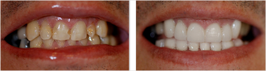 Fixed improperly shaped teeth before and after photo