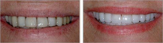 Yellowed or grayed with age teeth that were fixed before and after photo