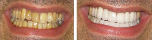 Yellow stained teeth that were whitened before and after photo