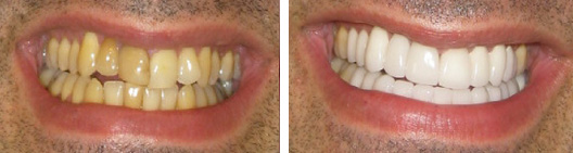 Yellow stained teeth that were whitened before and after photo