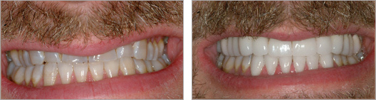 Teeth that were ground down and fixed before and after photo