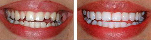 Teeth that were too small that got fixed before and after photo