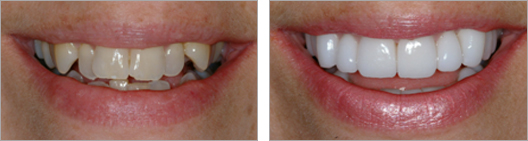 Fixed crooked teeth before and after photo