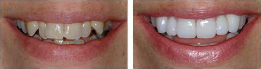 Fixed crooked teeth before and after photo