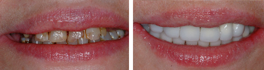 Full-mouth rehabilitation before and after photo