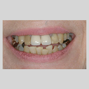 Smile Transformation Before & After Close Up of Teeth 03