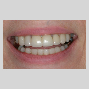 Smile Transformation Before & After Close Up of Teeth 04