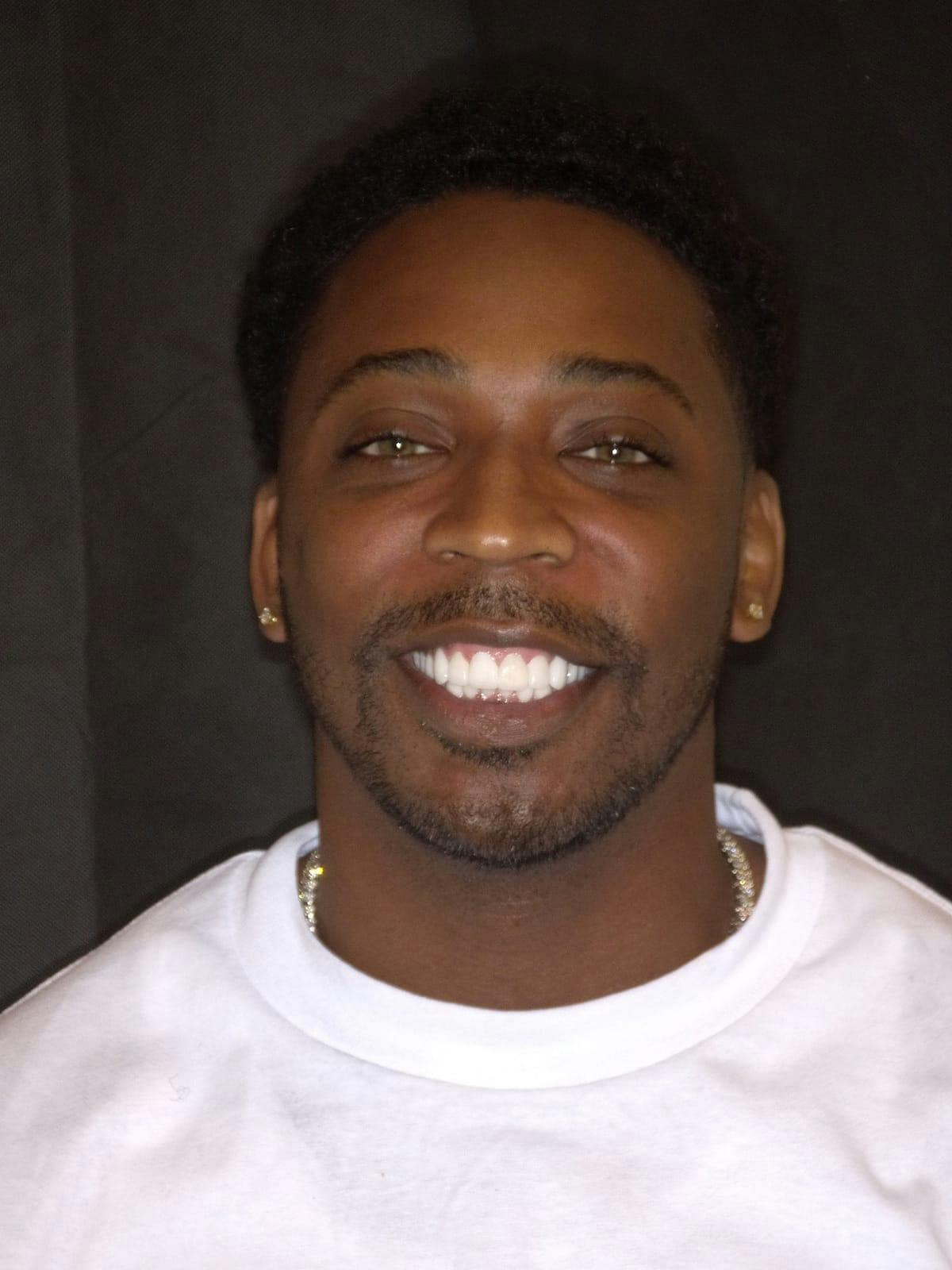 Man who got Infinity Veneers