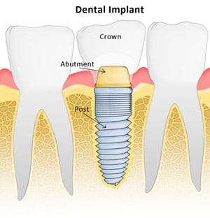 Diagram of a dental implant