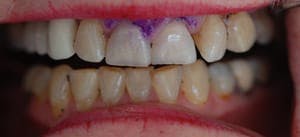 Close up of unhealthy teeth and gums, with purple discoloration in gums