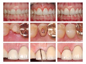 Collage of before and after photos following patients who Dr. Maddahi used the Waterlase MD Turbo machine on