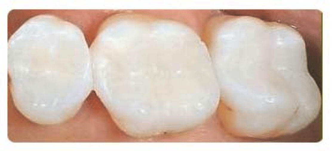 Close up of ceramic fillings in teeth