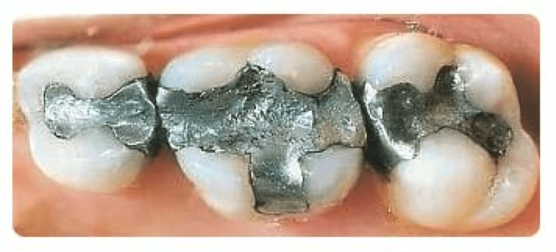 Close up of amalgam (metal) fillings in teeth