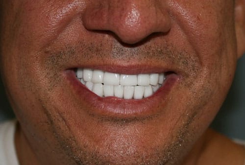 Photo of teeth after bite correction