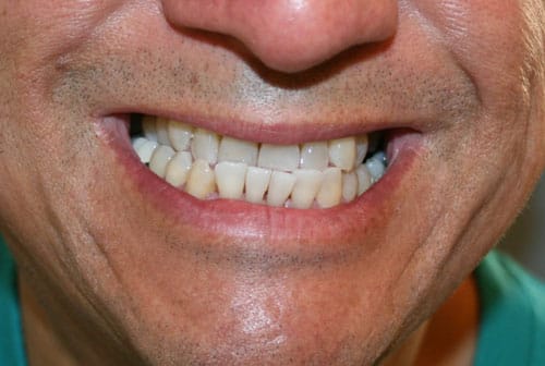 Photo of teeth before bite correction