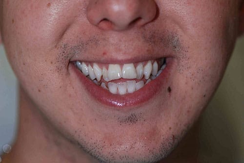 Photo of teeth before bite correction 02