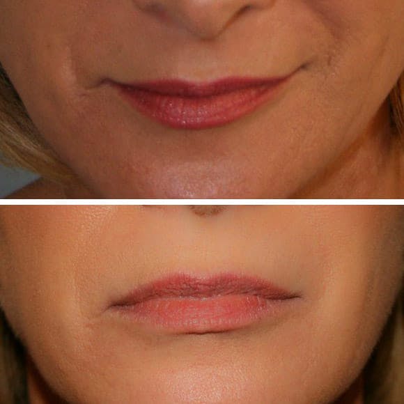 Horizontal folds in the corners of the lips