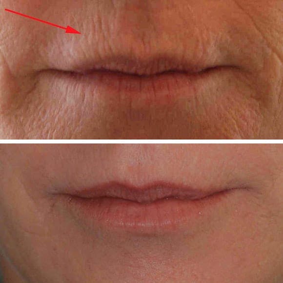 Smoker lines on face