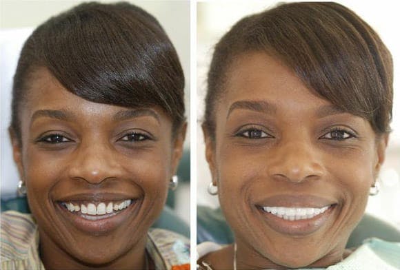 Smile lines above lips