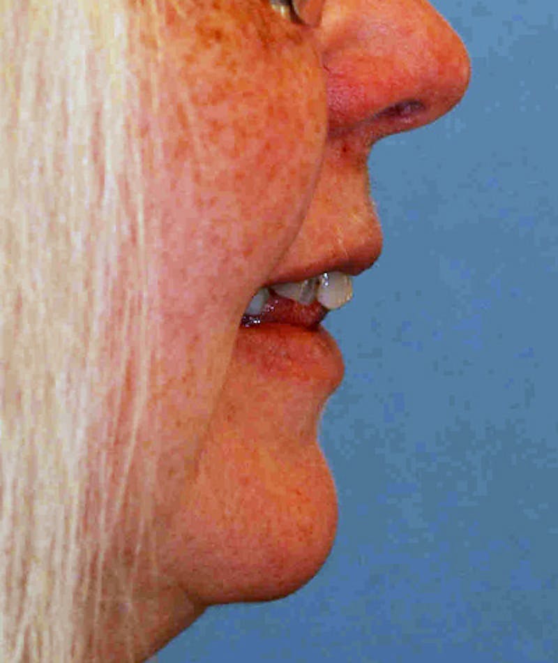 Anti Aging Before & After Gallery - Patient 96497738 - Image 4