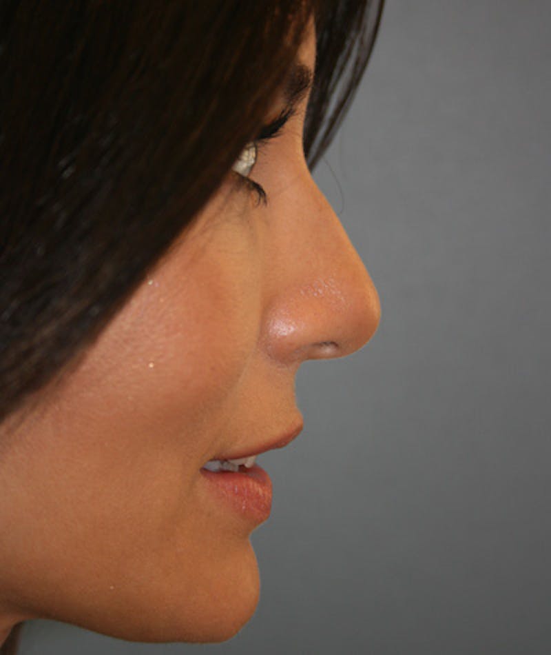 Anti Aging Gallery - Patient 96497761 - Image 4